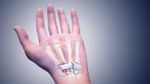 Chiropractors can help identify the root cause behind Carpal Tunnel Syndrome and successfully relieve its symptoms without any medication or surgery.